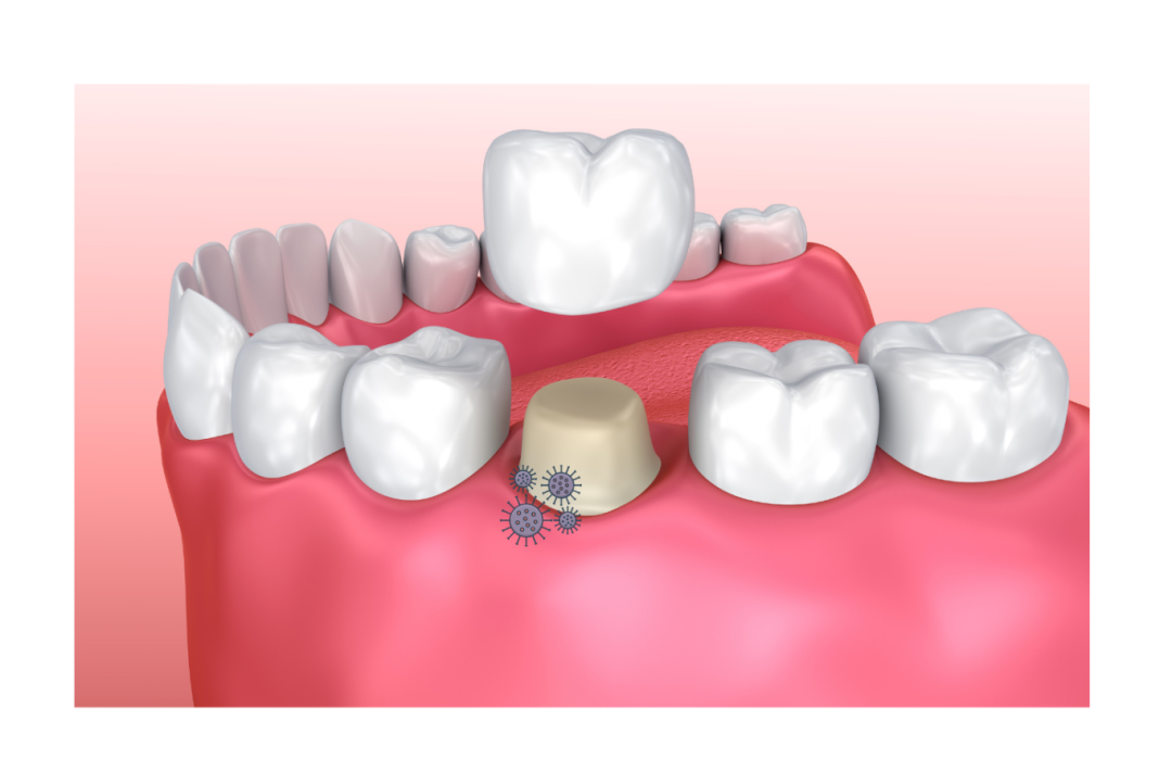 牙冠.png 牙冠.png