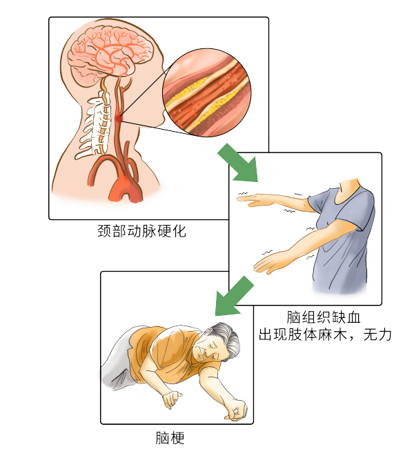 1.27脑梗 动脉粥样硬化.png 1.27脑梗 动脉粥样硬化.png