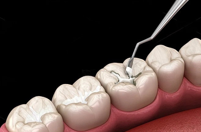 龋齿浅浅.png 龋齿浅浅.png