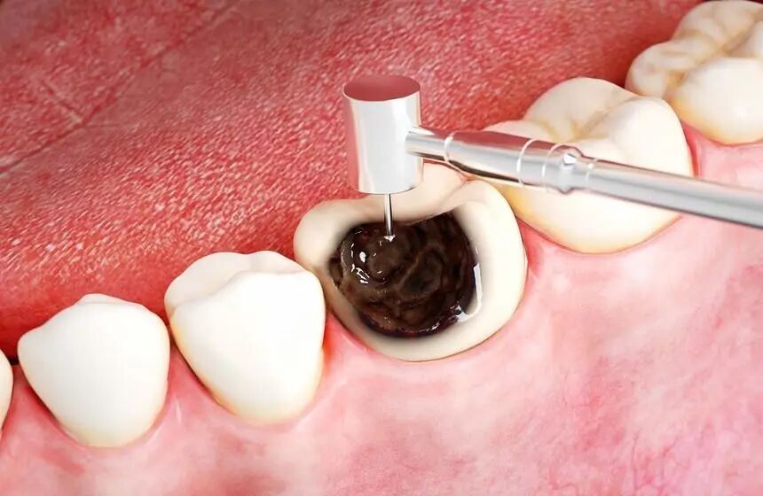 3.31龋齿.jpg 3.31龋齿.jpg