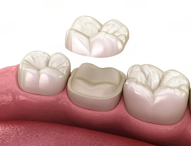 牙冠修复.png 牙冠修复.png