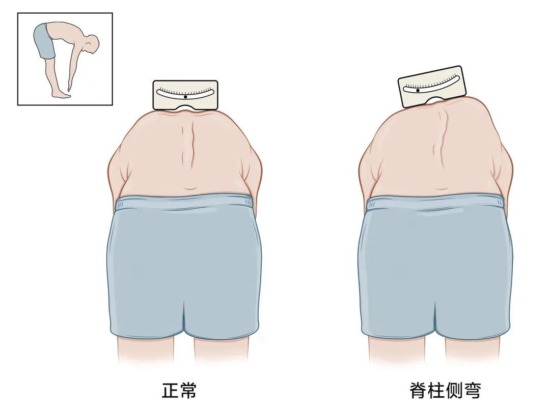 高低肩、长短腿……这种疾病让人越长越矮!-京东健康 高低肩、长短腿……这种疾病让人越长越矮!-京东健康