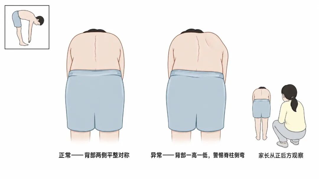 脊柱侧弯自查示意图.jpg 脊柱侧弯自查示意图.jpg