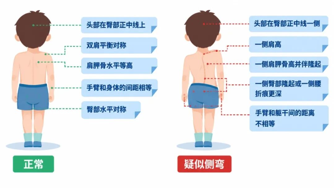 儿童脊柱侧弯对比插画 (1).jpg 儿童脊柱侧弯对比插画 (1).jpg