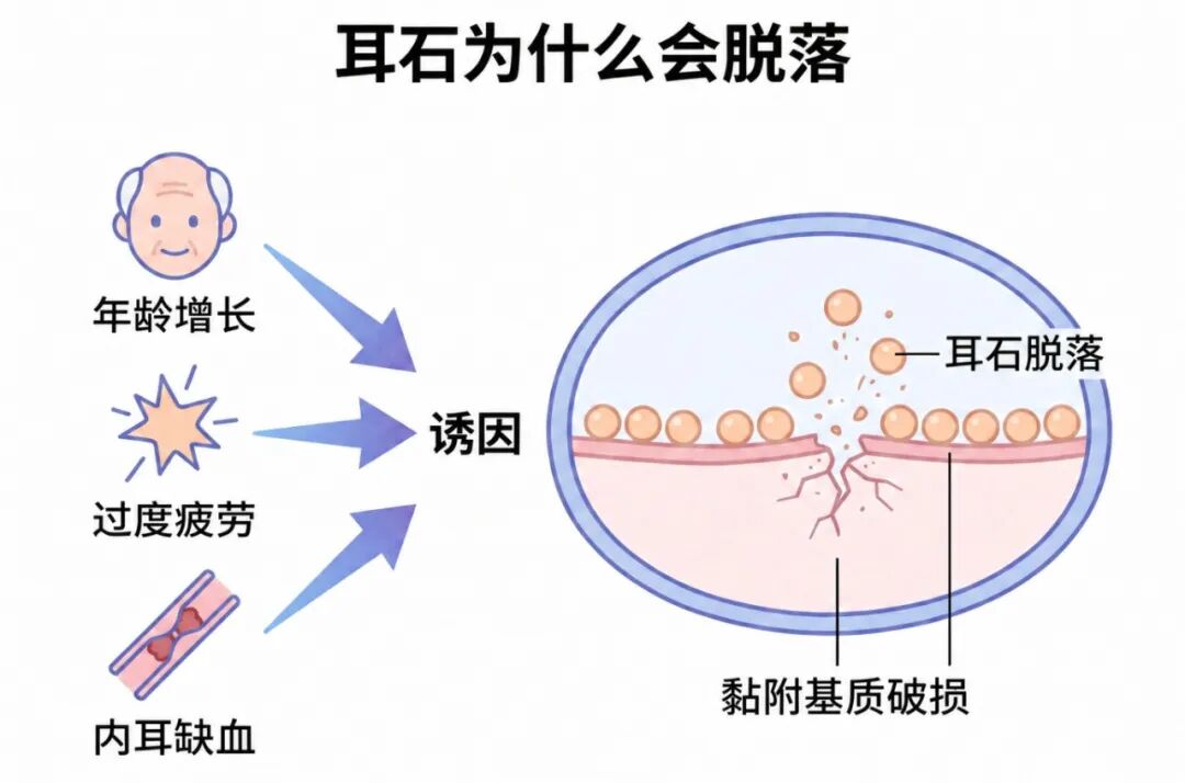 生成耳石症科普插图 (2).jpg 生成耳石症科普插图 (2).jpg