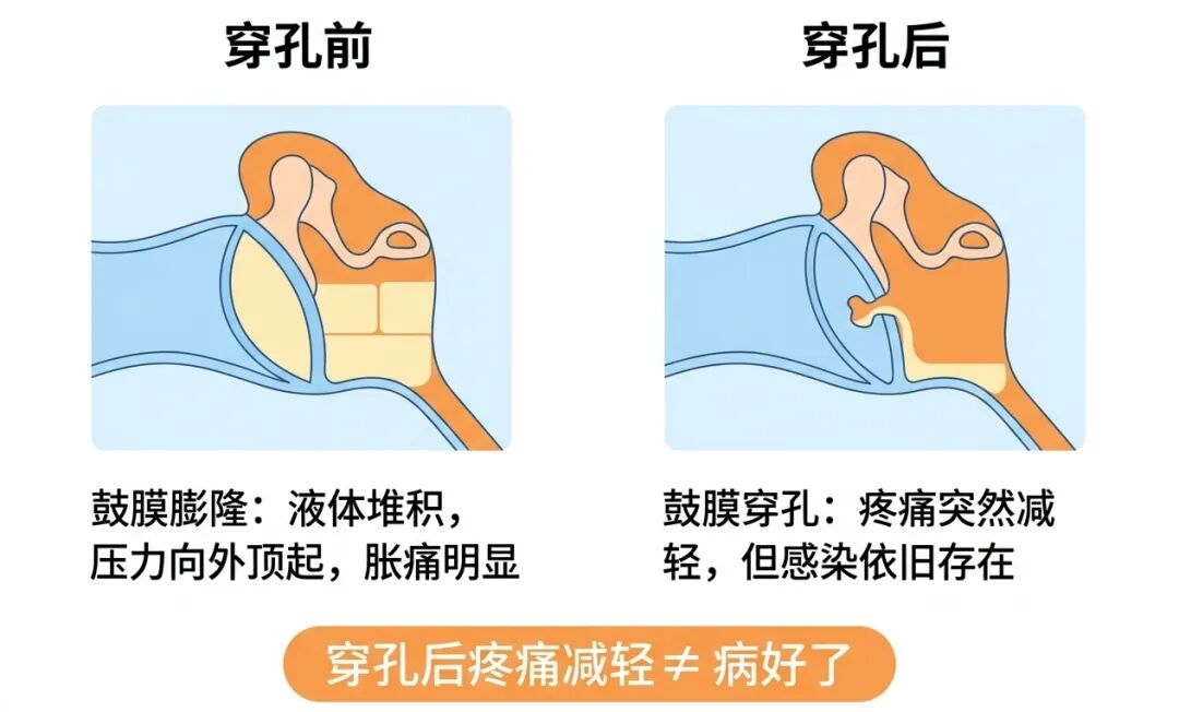 鼓膜对比科普图.jpg 鼓膜对比科普图.jpg